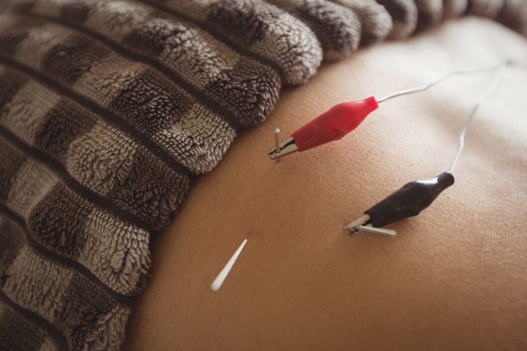 Jak korzyści z terapii akupunktury mogą wpływać na proces gojenia tatuażu?